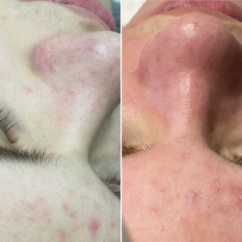 Чистка обличчя