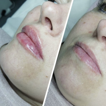 Контурна пластика губ