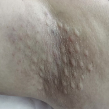 Лікування гіпергідрозу