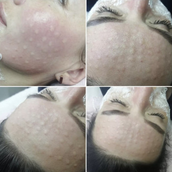 Біоревіталізація