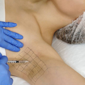 Лікування гіпергідрозу