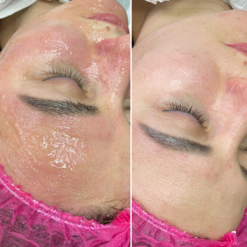 Карбоксітерапія