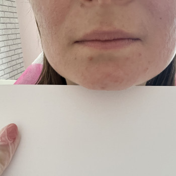 Контурна пластика обличчя
                    Косметолог Вероніка Винница