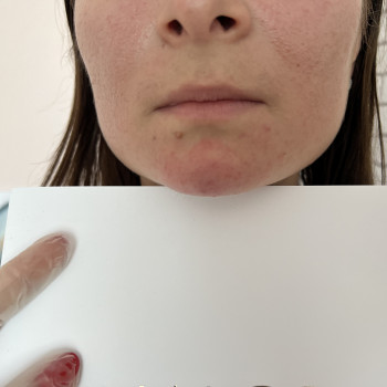 Контурна пластика обличчя
                    Косметолог Вероніка Винница