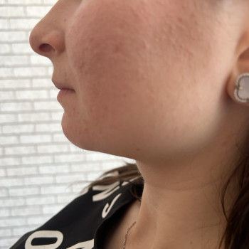 Контурна пластика обличчя
                    Косметолог Вероніка Винница