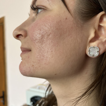 Контурна пластика обличчя
                    Косметолог Вероніка Винница