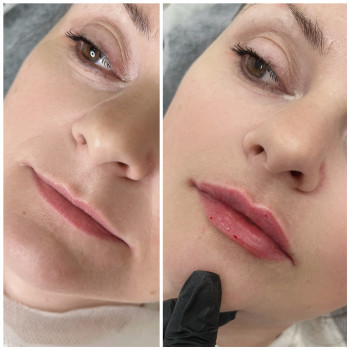 Збільшення губ
                    Косметолог-инъекционист Наталья Днепр