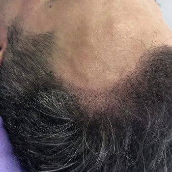 SMP - мікропігментація шкіри голови (медичне татуювання) - тріхопігментація
                    Тату мастер Лариса Львов