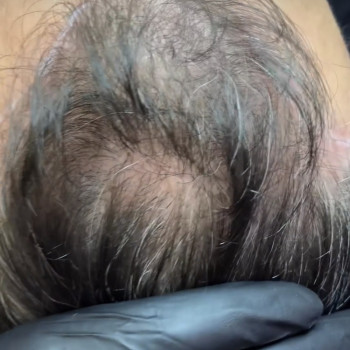 SMP - мікропігментація шкіри голови (медичне татуювання) - тріхопігментація
                    Тату мастер Лариса Львов