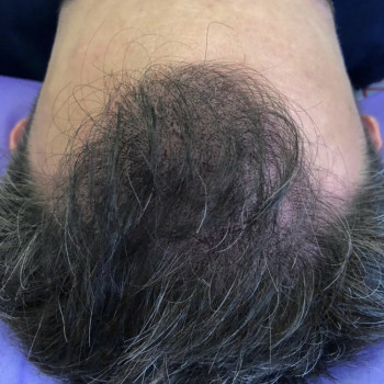 SMP - мікропігментація шкіри голови (медичне татуювання) - тріхопігментація
                    Тату мастер Лариса Львов