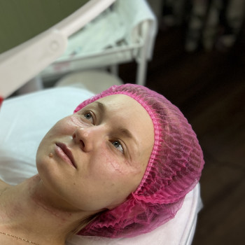 Біоревіталізація | Rejuran HB, 1 мл | обличчя, шия, тильна сторона рук
                    Косметолог-естетист Наталія Бориспіль