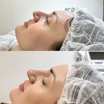 Корекція носа