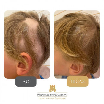 Лікування облисіння у Клініці Мирослави Новосільської