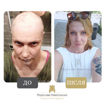 Лікування облисіння у Клініці Мирослави Новосільської