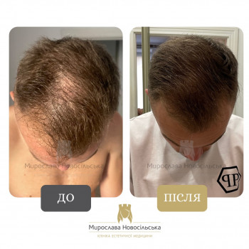 Лікування облисіння у Клініці Мирослави Новосільської