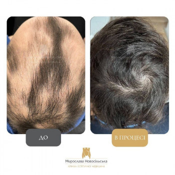 Лікування облисіння у Клініці Мирослави Новосільської