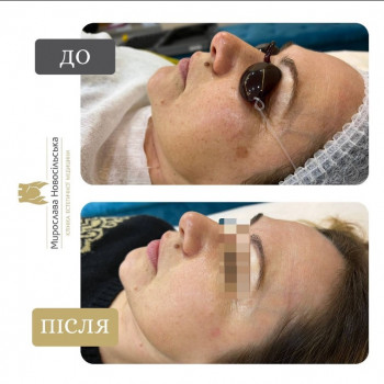 лазерне видалення пігментації у Львові