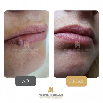 Лазерне видалення новоутворів у Львові