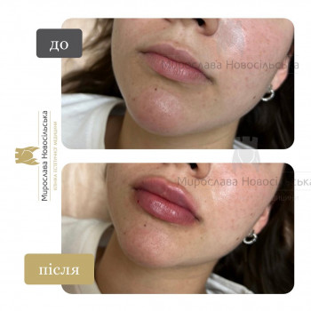 Контурна пластика губ у Львові