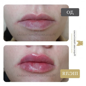 Контурна пластика губ у Львові