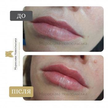 Збільшення губ у Львові