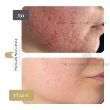 Лазерне шліфування шкіри обличчя у Львові