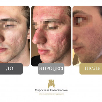 Лазерне шліфування шкіри обличчя у Львові