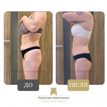 Апаратний масаж Стратосфера у Львові, фото до/після