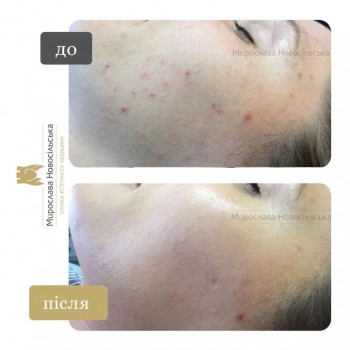 Лазерне лікування акне у Львові