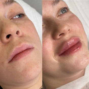 Контурна пластика губ, фото - Лікар-косметолог Наталія Морару