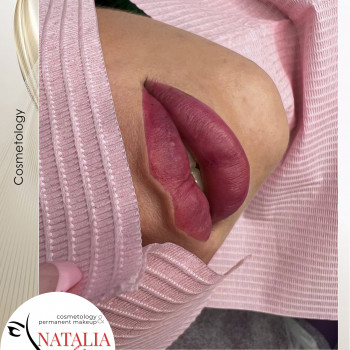 Аугментація губ (збільшення губ) від косметолога Наталії Філь

   