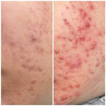 Лікування проблемної шкіри