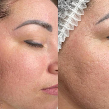 Омолодження обличчя