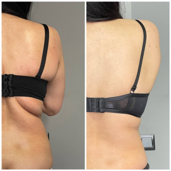 Корекція силуету
антицелюлітний масаж
масаж живота