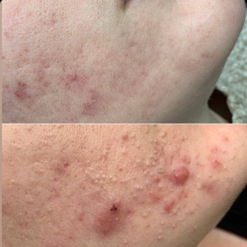 лікування проблемної шкіри