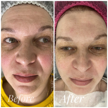 Пілінг PRX-t33