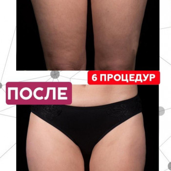 Антицелюлітний комплекс з обгортанням
                    Массажный салон Terra SPA Вишнёвое