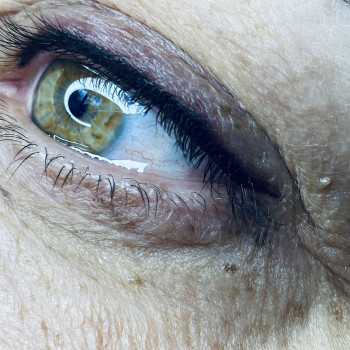 Межресничка