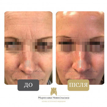 Лазерне 4Д Омолодження у Львові