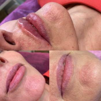 Контурна пластика губ
                    Косметолог Людмила Киев