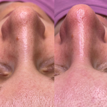 Пілінг МСА - 35
                    Косметолог Людмила Киев