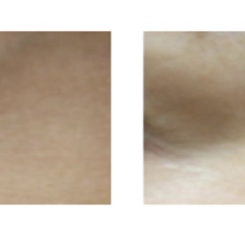 Розгладжує зморшки, зменшує темні кола під очима