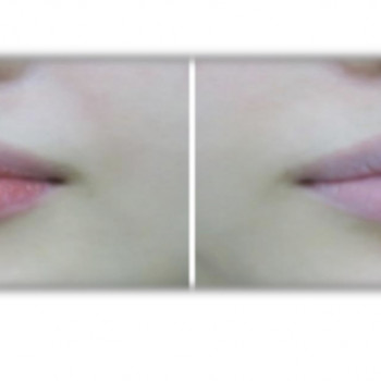 Додає природнього обʼєму губам