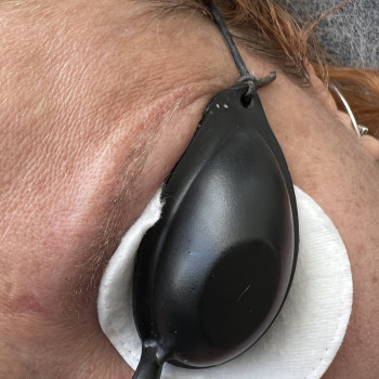 Видалення татуажу брів