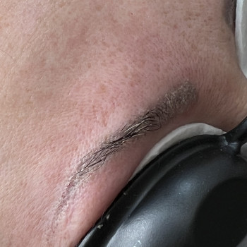 Видалення татуажу брів