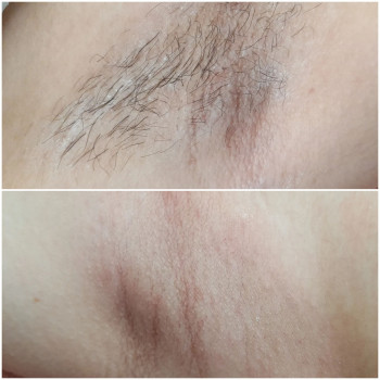 Шугаринг
                    Майстер депіляції Маріна Хмільник