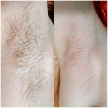 Шугаринг
                    Майстер депіляції Маріна Хмільник