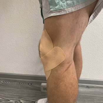 Тейпування