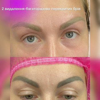 Видалення багаторазово перекритих брів