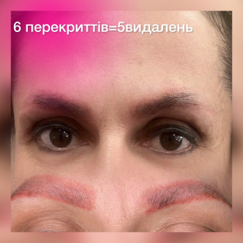 5сеансів комбінованого видалення -багаторазовопепекритих брів